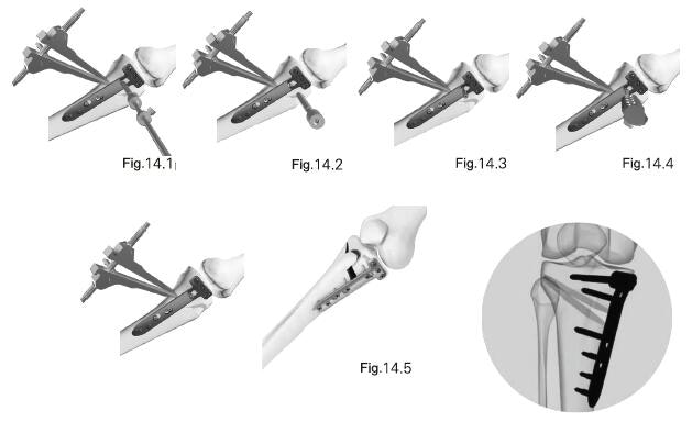 Periarticular Locking Plate System gallery image