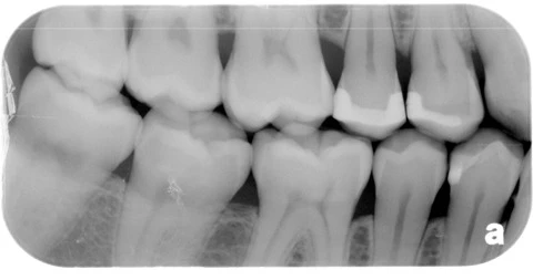 Regrow Tooth Enamel Naturally