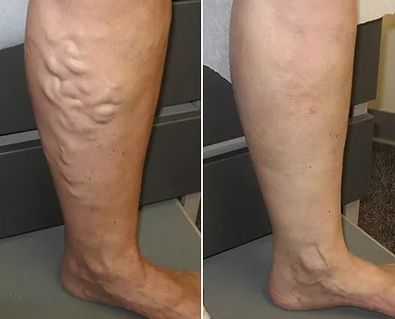 Varicose Veins Treatments