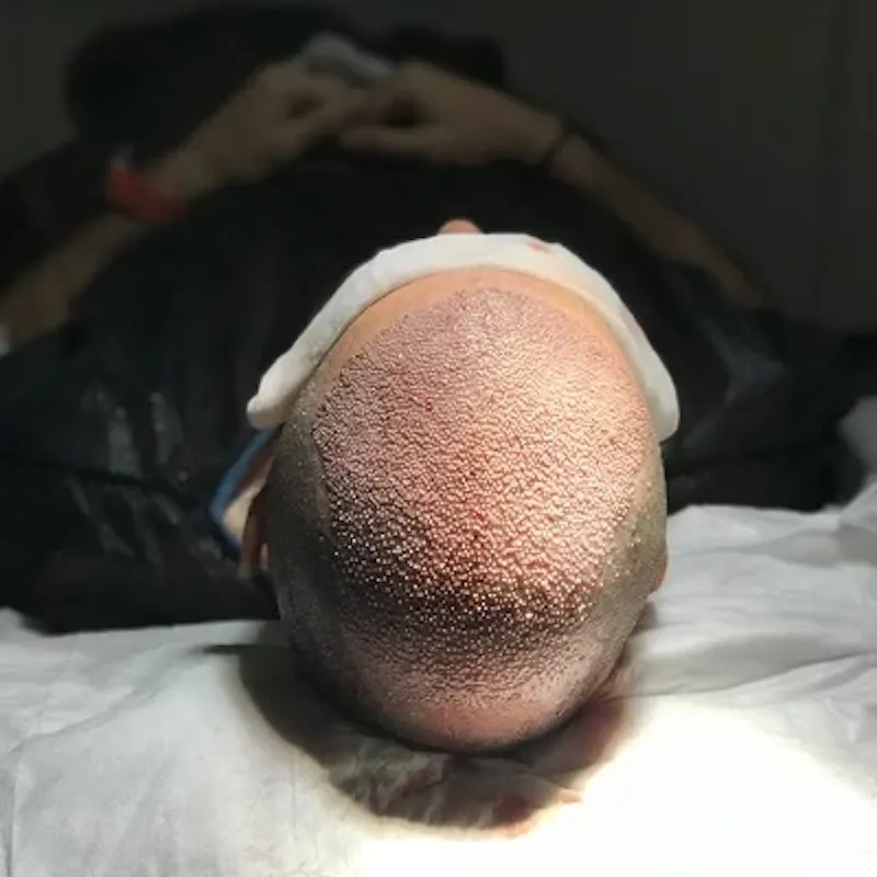 FUE Hair Transplant in Islamabad screenshot 1