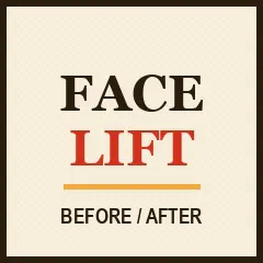 Facelift