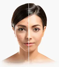 PRP for Skin Anti-aging in Noida gallery image