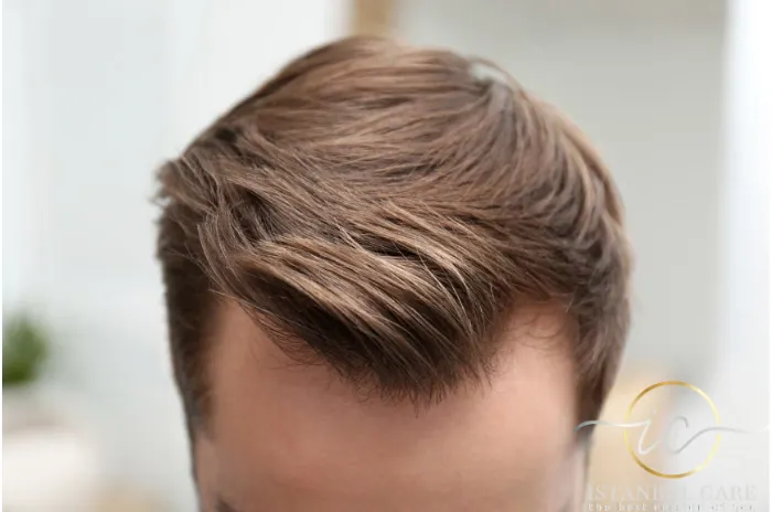 Hair Transplant B/A Projector gallery image