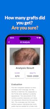 Hair Transplant AI Success gallery image