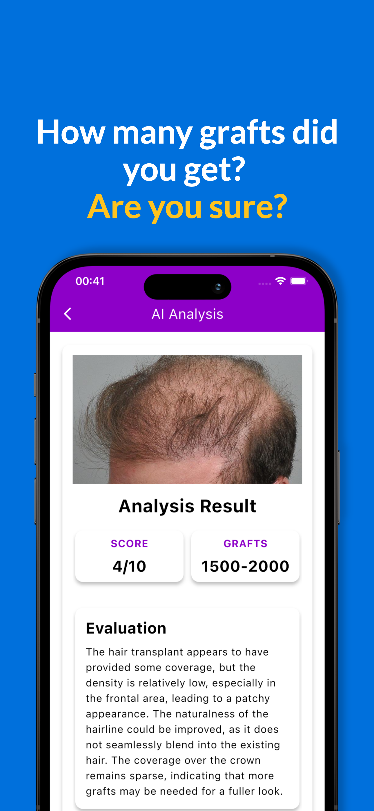 Haartransplantatie AI Succes media 1