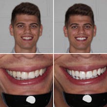 HaloSmile gallery image