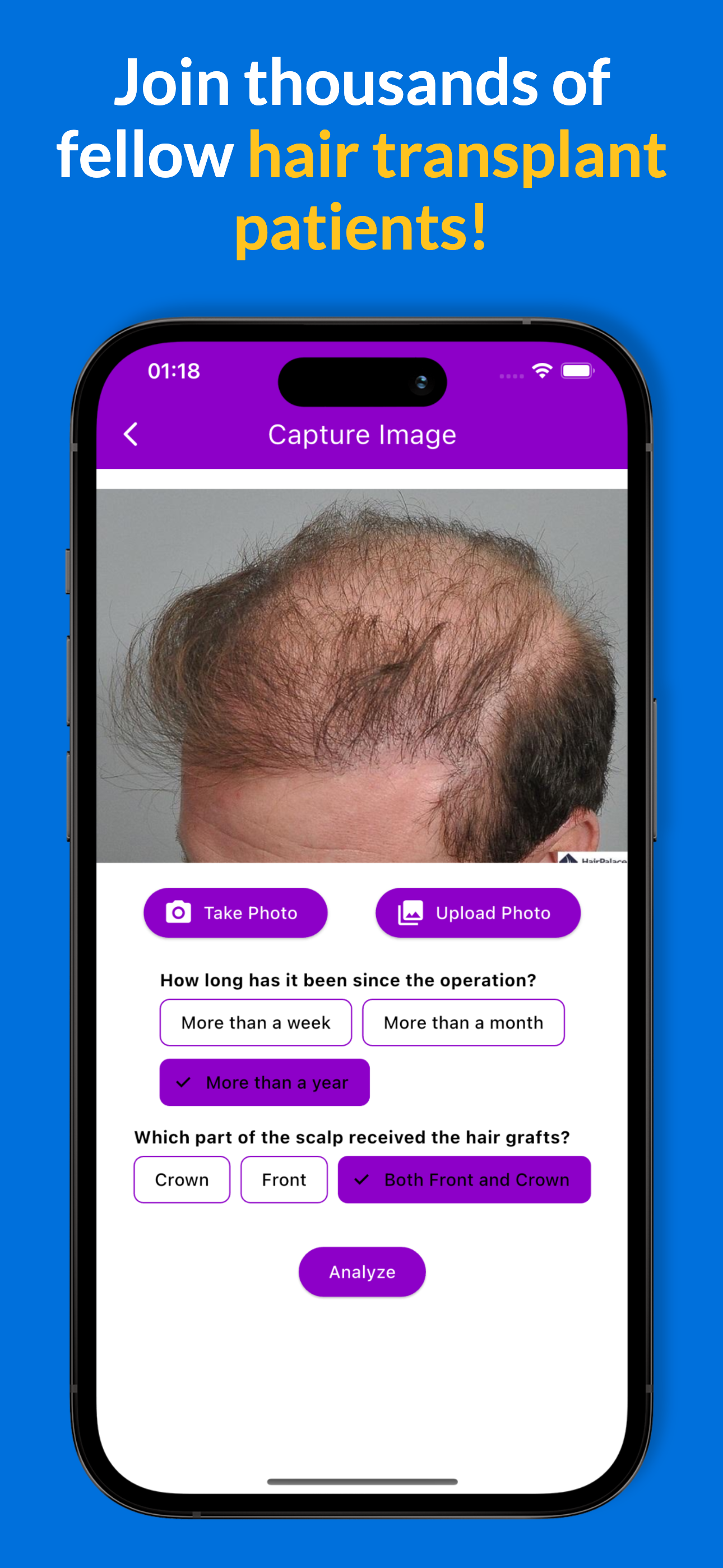 Haartransplantatie AI Succes media 2
