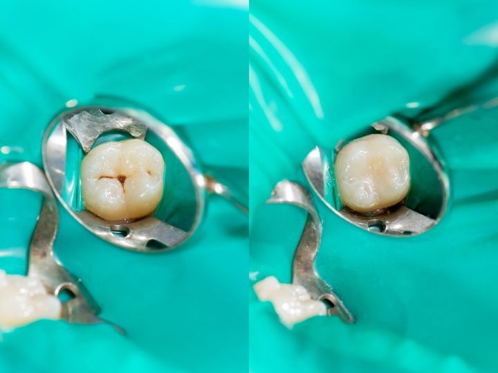 fissure sealants