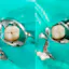 fissure sealants