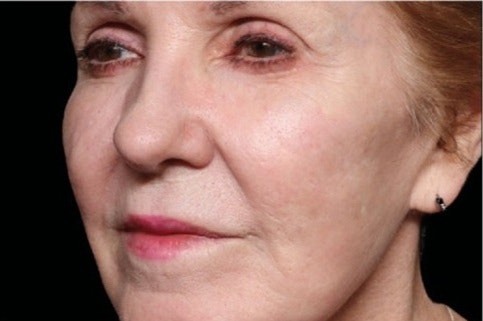  Exion Facial gallery image