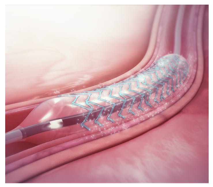  coronary stent  media 1