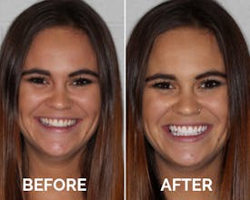 HaloSmile gallery image