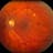 Diabetic Retinopathy