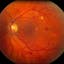 Diabetic Retinopathy