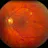 Diabetic Retinopathy