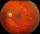Diabetic Retinopathy