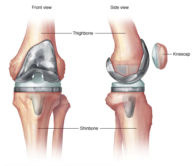 Dr.Vivek - ACL -Behandlung in Chennai Medien 2