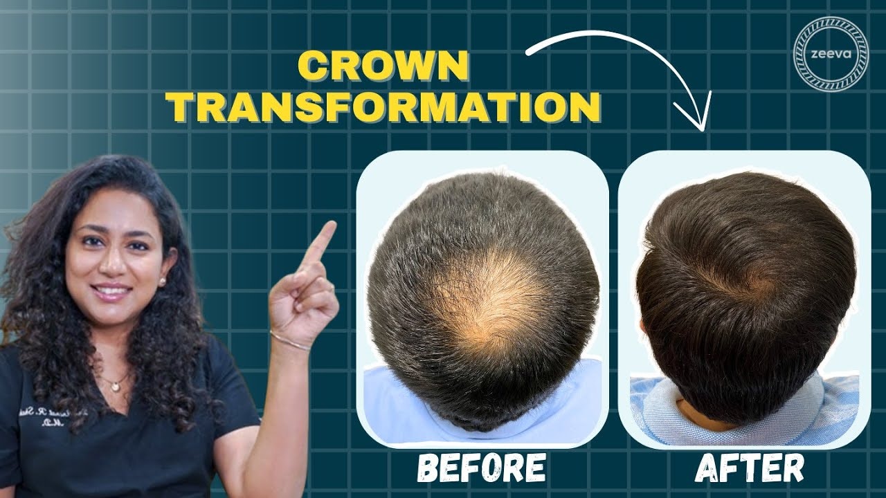 No 1 Hair Transplant Clinic in Ahmedabad gallery image