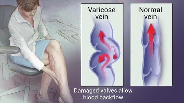 Trattamenti delle vene varicose - One Stop Clinic per vene varicose media 2