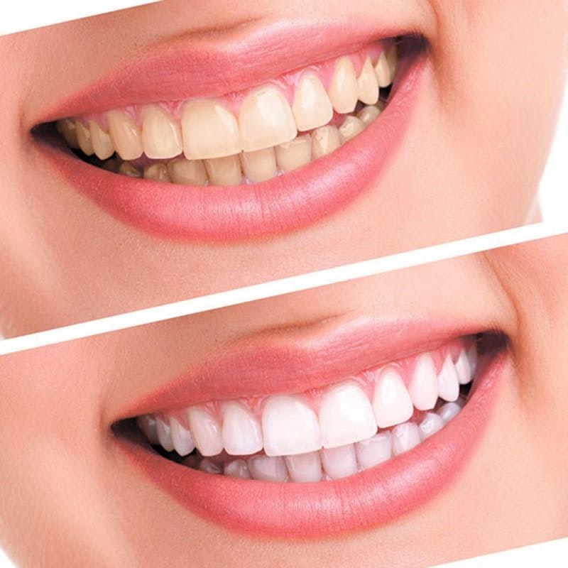 Onyx Smile Teeth Whitening Kit gallery image
