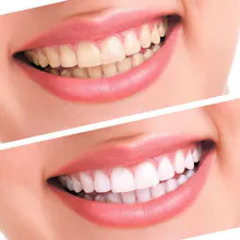 Onyx Smile Teeth Whitening Kit gallery image