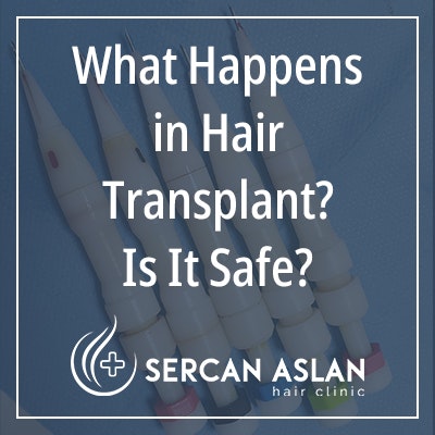 Hair Transplant Informal Blog gallery image