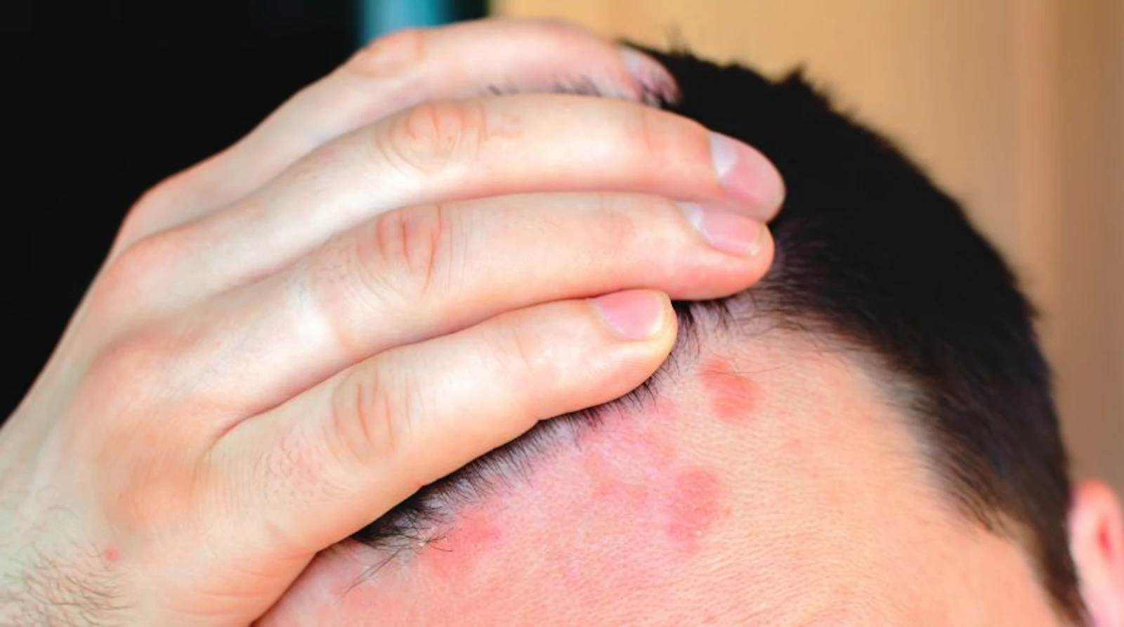 Dandruff treatment in Wakad screenshot 1