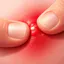Pimple Pop 3d