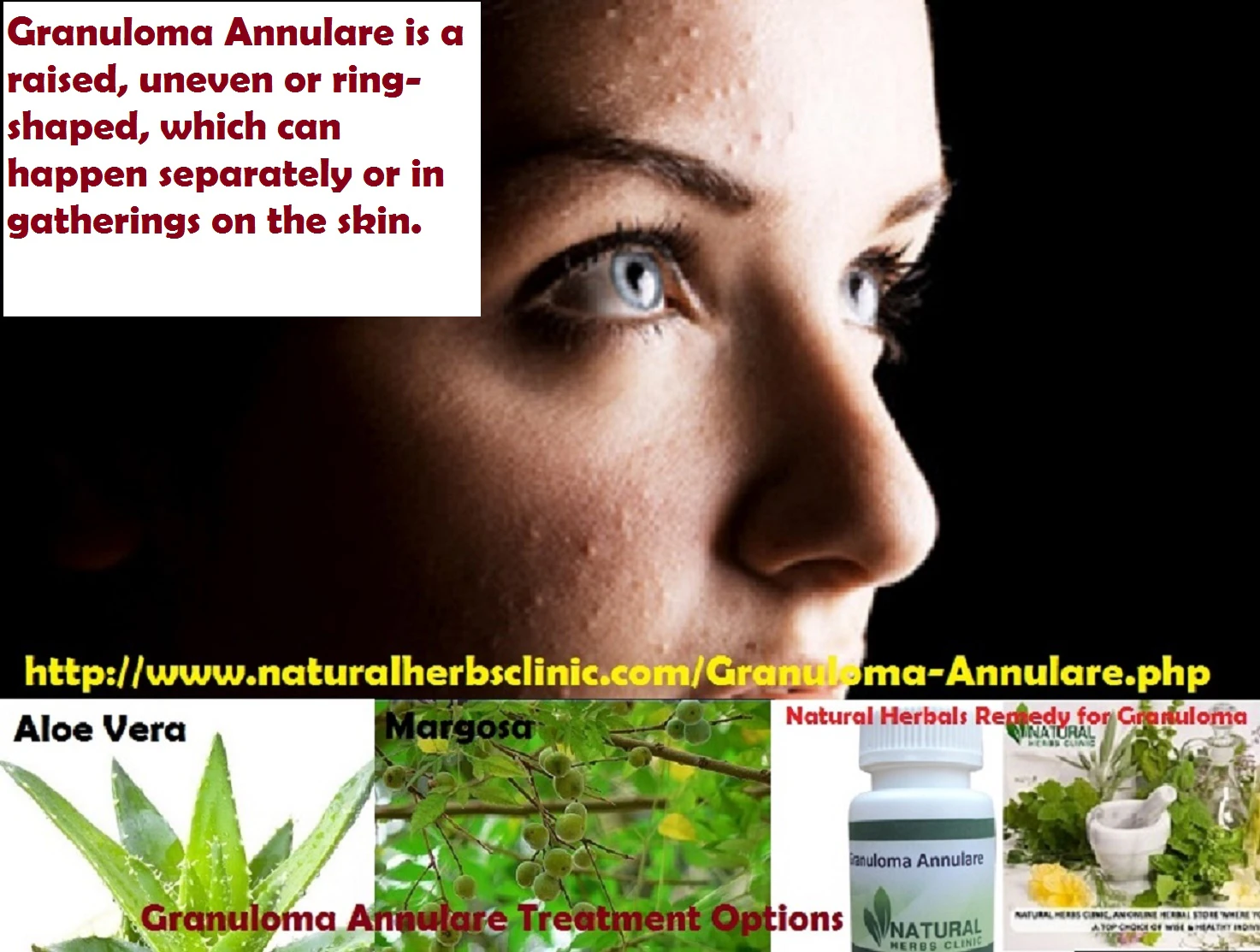 Granuloma Annulare Natural Treatment
